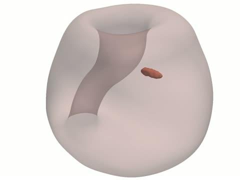 Cancer Growth
