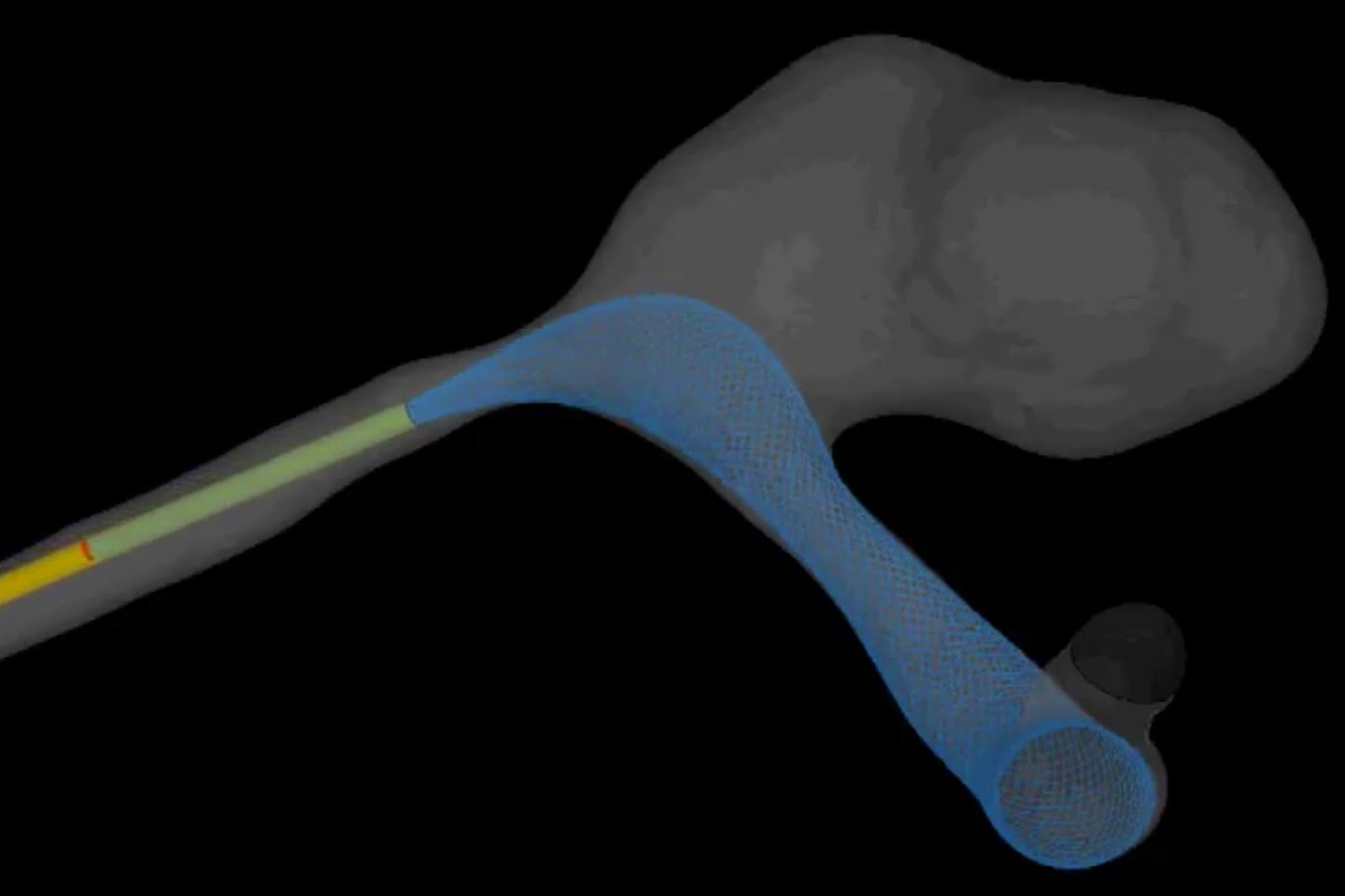 When Treating Brain Aneurysms, Two Isn't Always Better than One 2