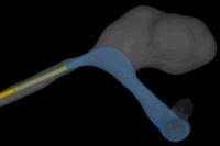 When Treating Brain Aneurysms, Two Isn't Always Better than One 2