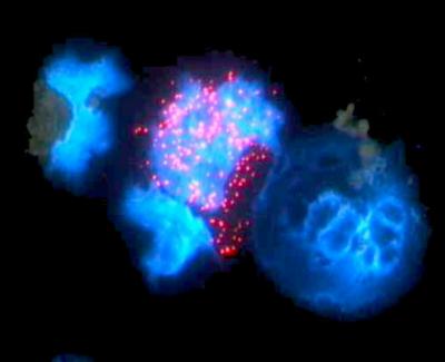 Gene Therapy Technique Slows Brain Disease (1 of 2)