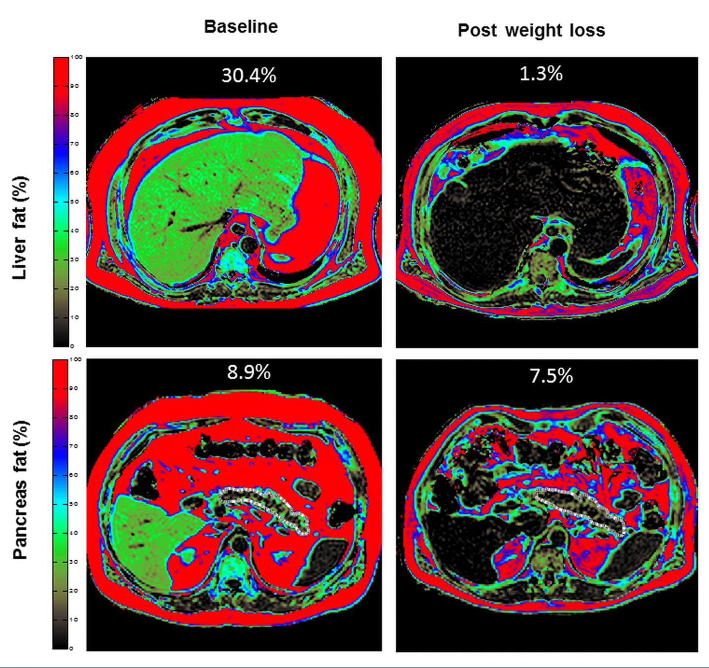 MRI Images of Liver and Pancreas Fat