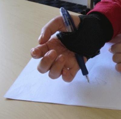 Hand Surgery Enhances Life Quality (1 of 2)