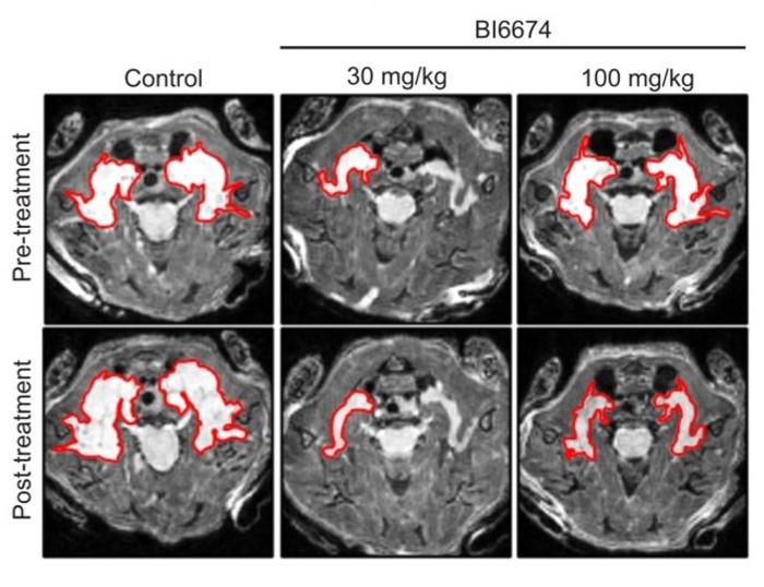 New Approach to Shrinking NF1 Tumors