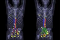 A 3-dimensional Map of the PSMA-positive Lesions Outside the Standard Radiation Fields