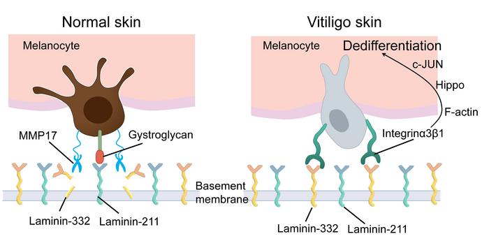 How changes in melanocyte attachment to the extracellular layer drive vitiligo