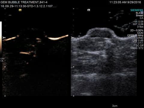 Microbubbles Make Breast Cancer More Susceptible to Radiation Therapy