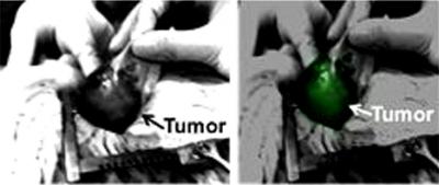 Glowing Lung Tumor