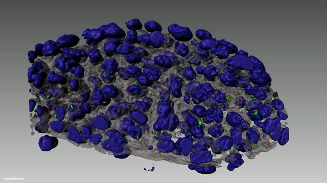 Defects in Cellular Antennae Can Cause a Common Heart Condition (2 of 3)