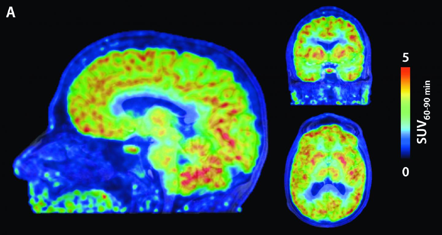 First Visualization of Epigenetic Activity in Living Human Brain