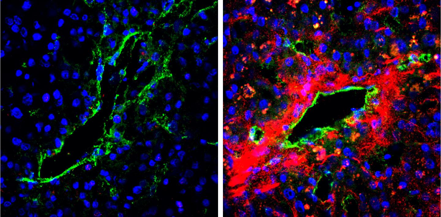 The Secretion of Biglycan in Tumor Blood Vessels of Cancer Patients