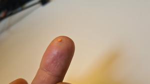 Size of eye implant