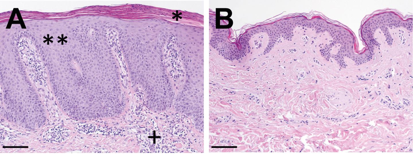 Psoriasis: Histological Skin Examination