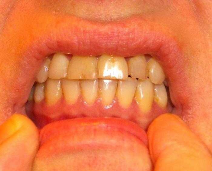 Adult orthodontic care