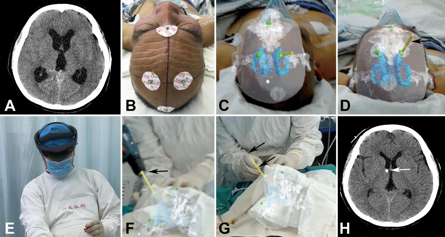 Hologram-guided Operation Procedures Flanked by Preop and pPstop CT Scans