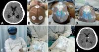 Hologram-guided Operation Procedures Flanked by Preop and pPstop CT Scans