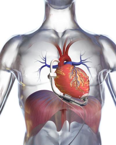 DeBakey Heart Assist