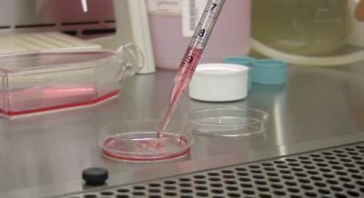 Resveratrol Melanoma Study