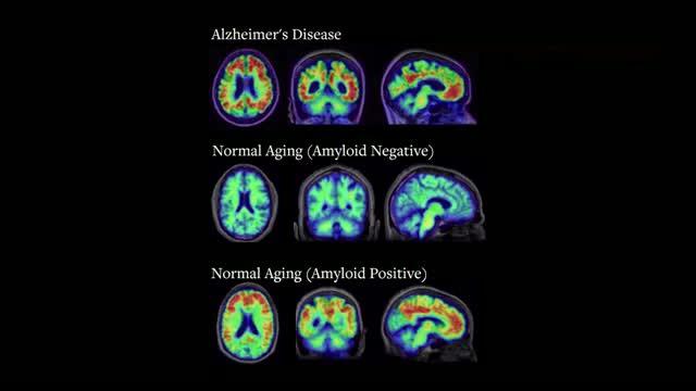 Tracking the Onset of Alzheimer's