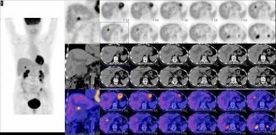 Gall Bladder Cancer