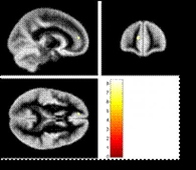 Voxel-Based Morphometric Analysis