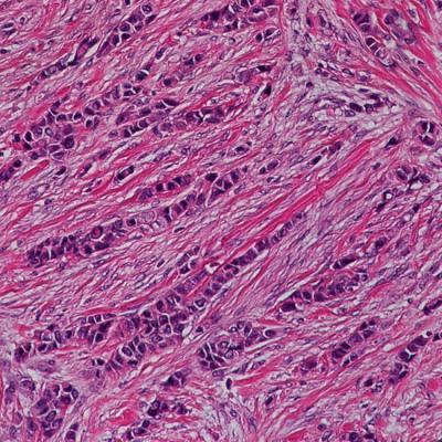 Invasive Lobular Carcinoma