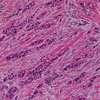 Invasive Lobular Carcinoma