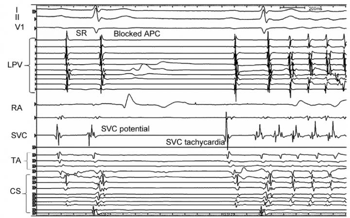 SVC-derived AF