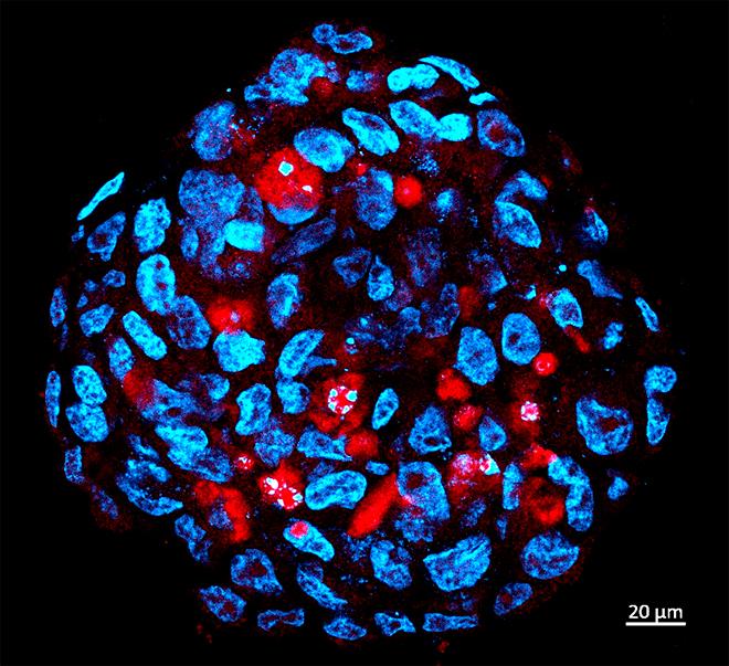 Medulloblastoma 1