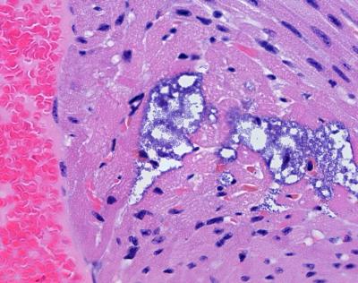 Pneumonia's Damage to a Mouse Heart