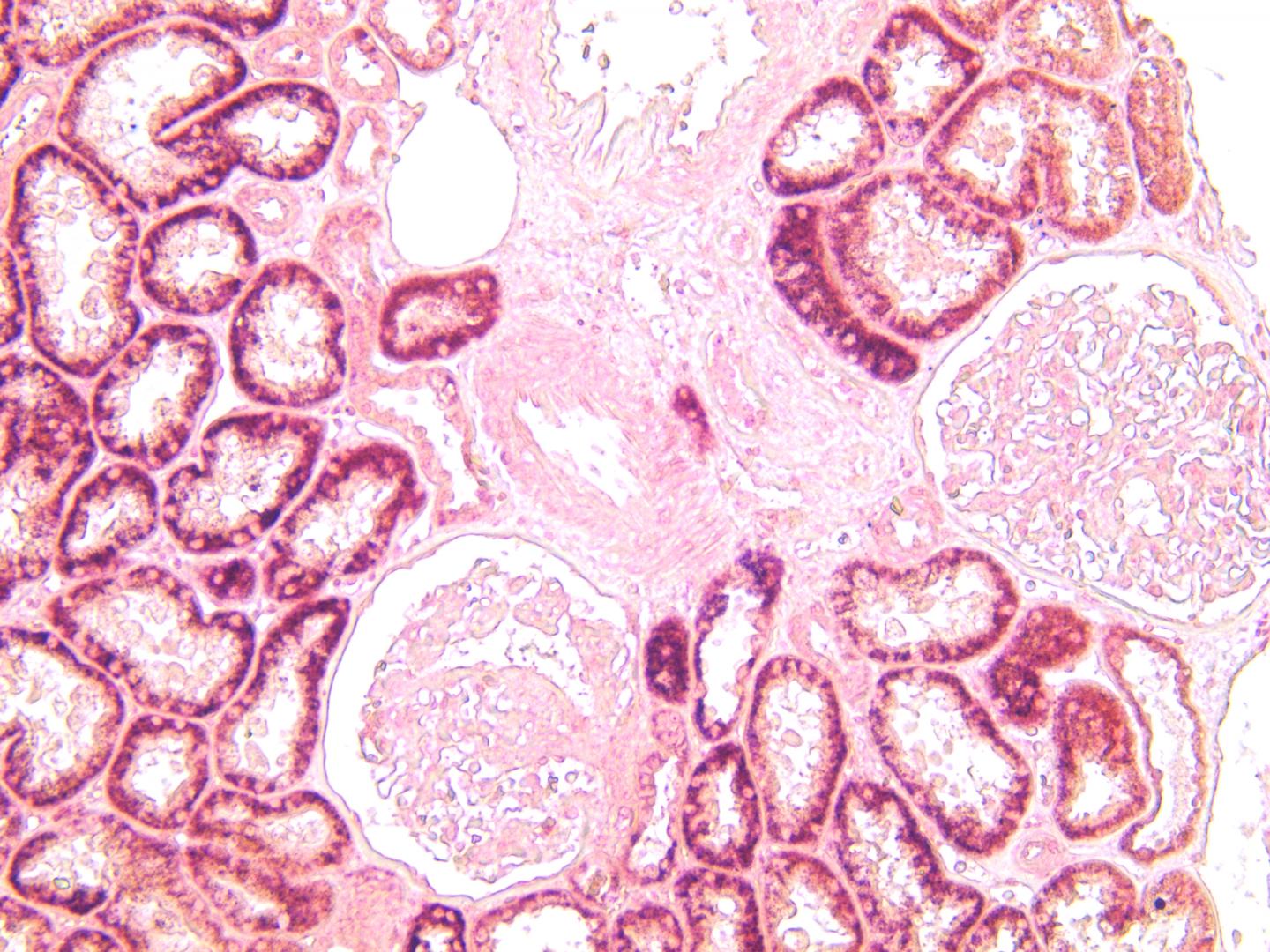 New RNA Molecule Counteracts Kidney Fibrosis in Chronic Kidney Disease (1 of 1)