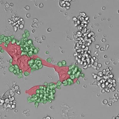 Immune Cells Attacking Tumor Cells