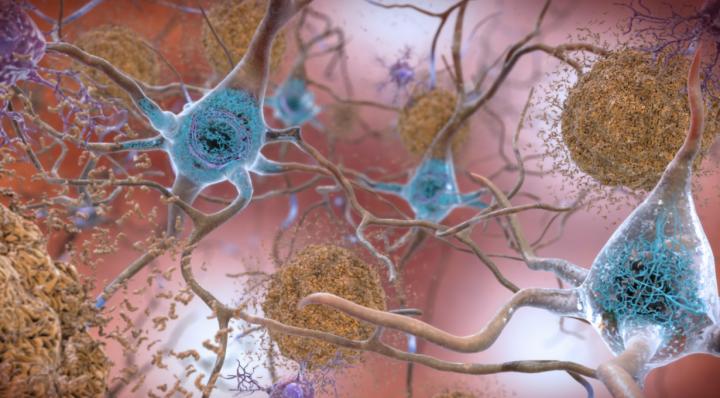 beta-amyloid plaques