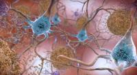 beta-amyloid plaques