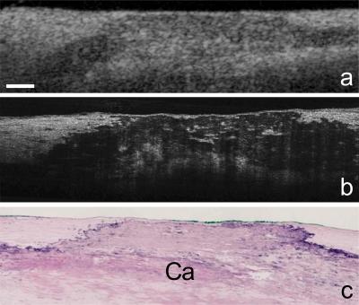 Coronary Artery Plaque