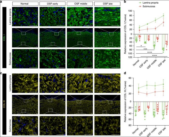 Pathological characteristics of abnormal collagen I and collagen III accumulation during OSF progression.