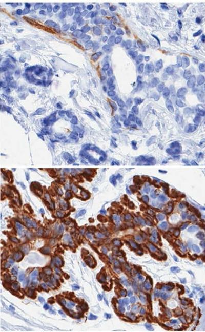 Breast Cells Stained for Keratin in Older and Younger Women