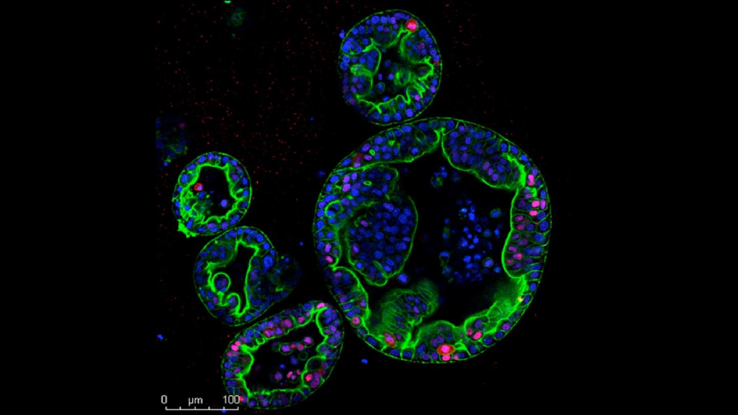 Human Pancreas Tumor Organoids