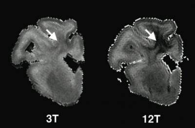 MRI