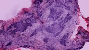 Human breast tissue imaged with SCOPE