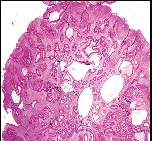 Cronkhite–Canada syndrome (CCS) is characterized by diffuse gastrointestinal polyposis