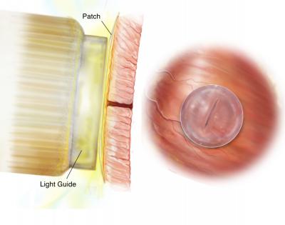 Light-Activated Glue for a Broken Heart (4 of 7)