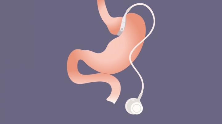 Bariatric Surgery