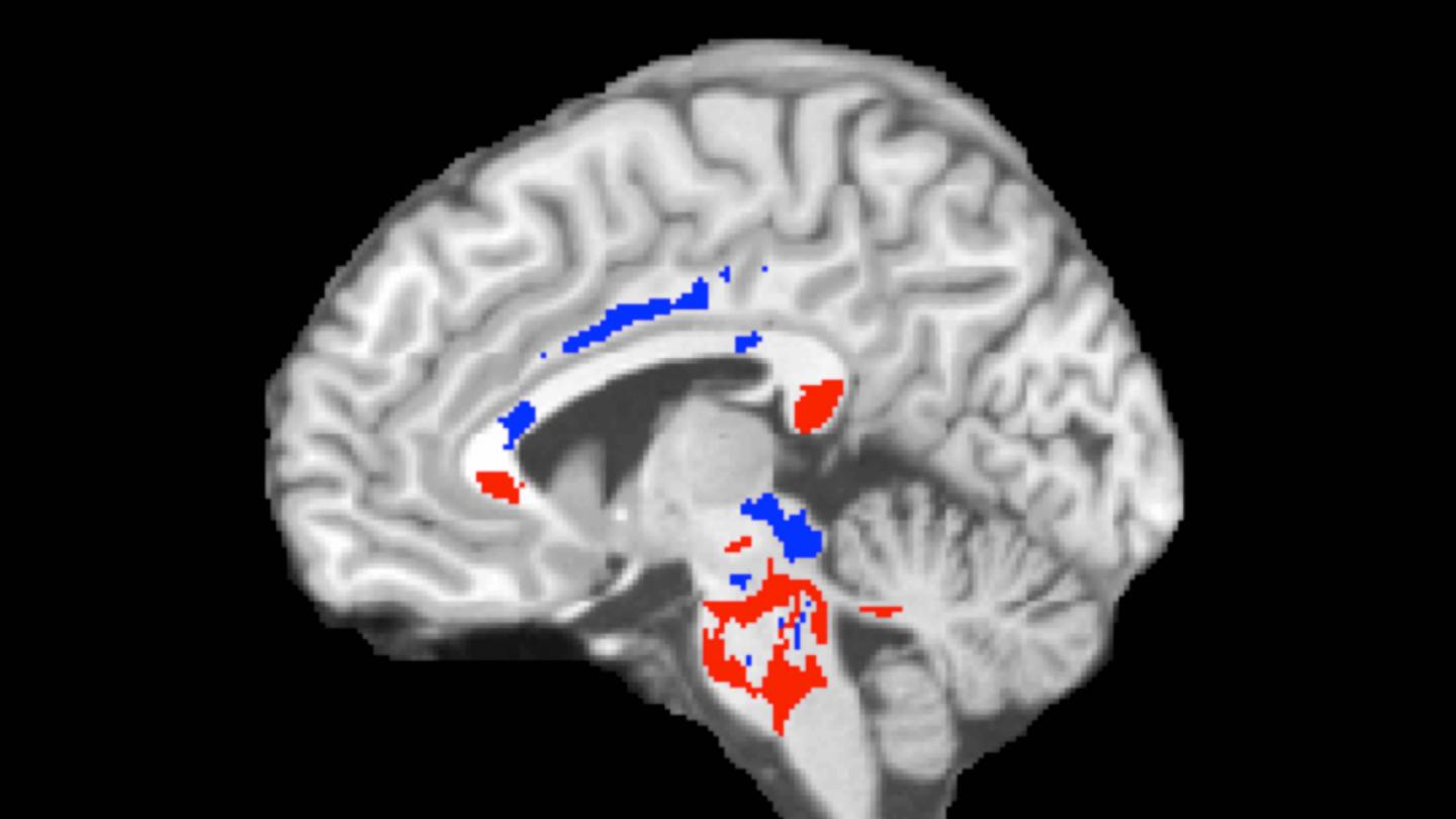 Concussion Patient's Brain