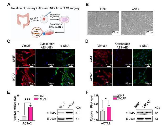 Highly purified fibroblasts were successfully obtained from human CRC tissues.