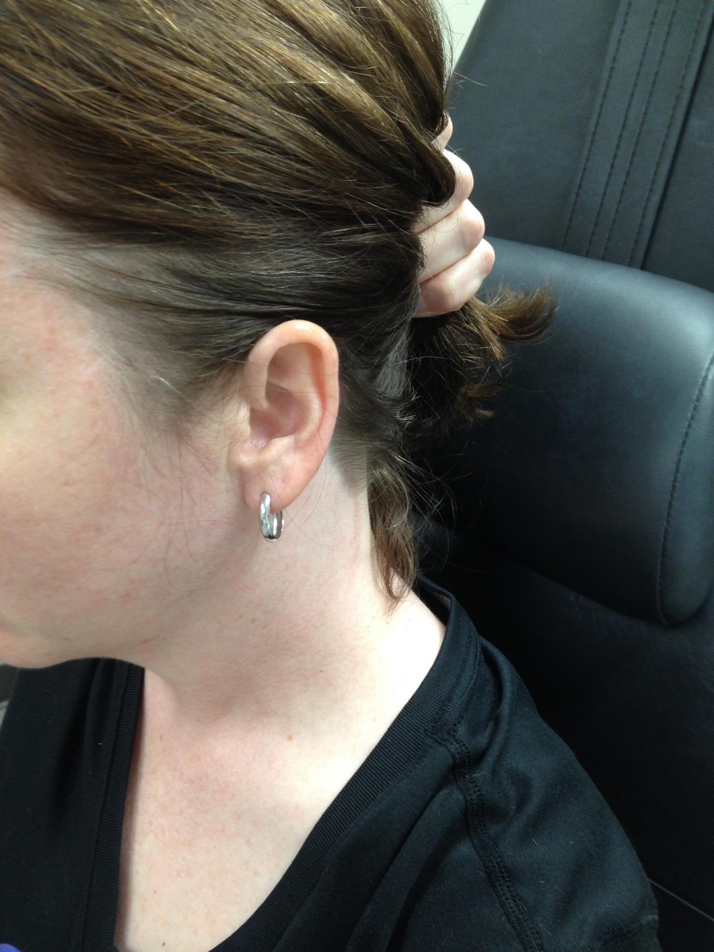New Approach Thyroidectomy Scar