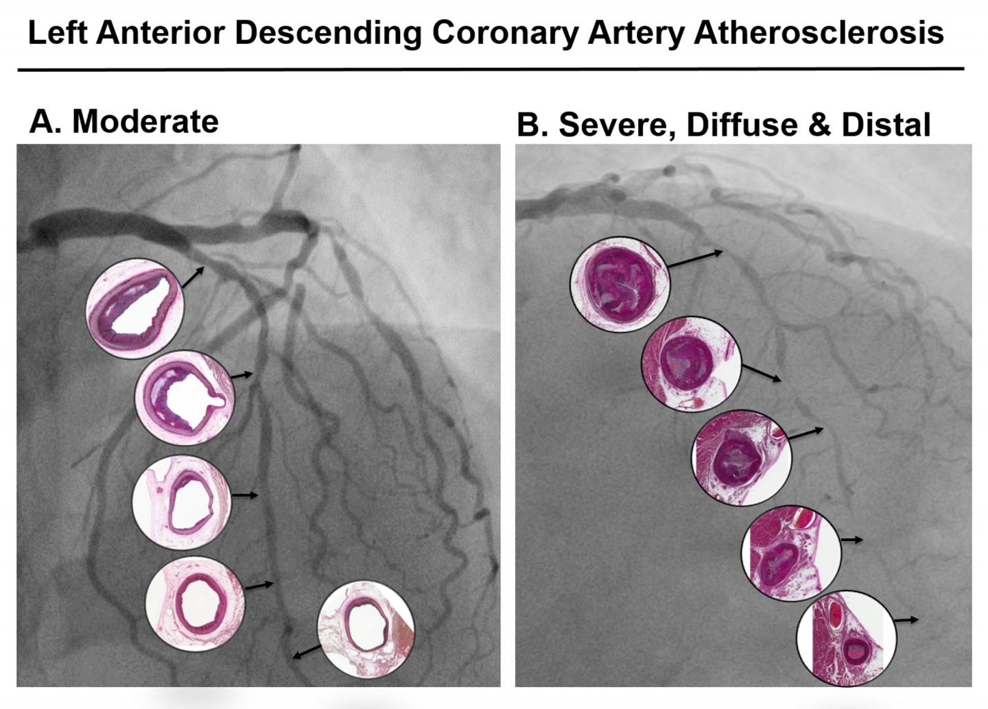 Moderate vs. Severe Heart Disease