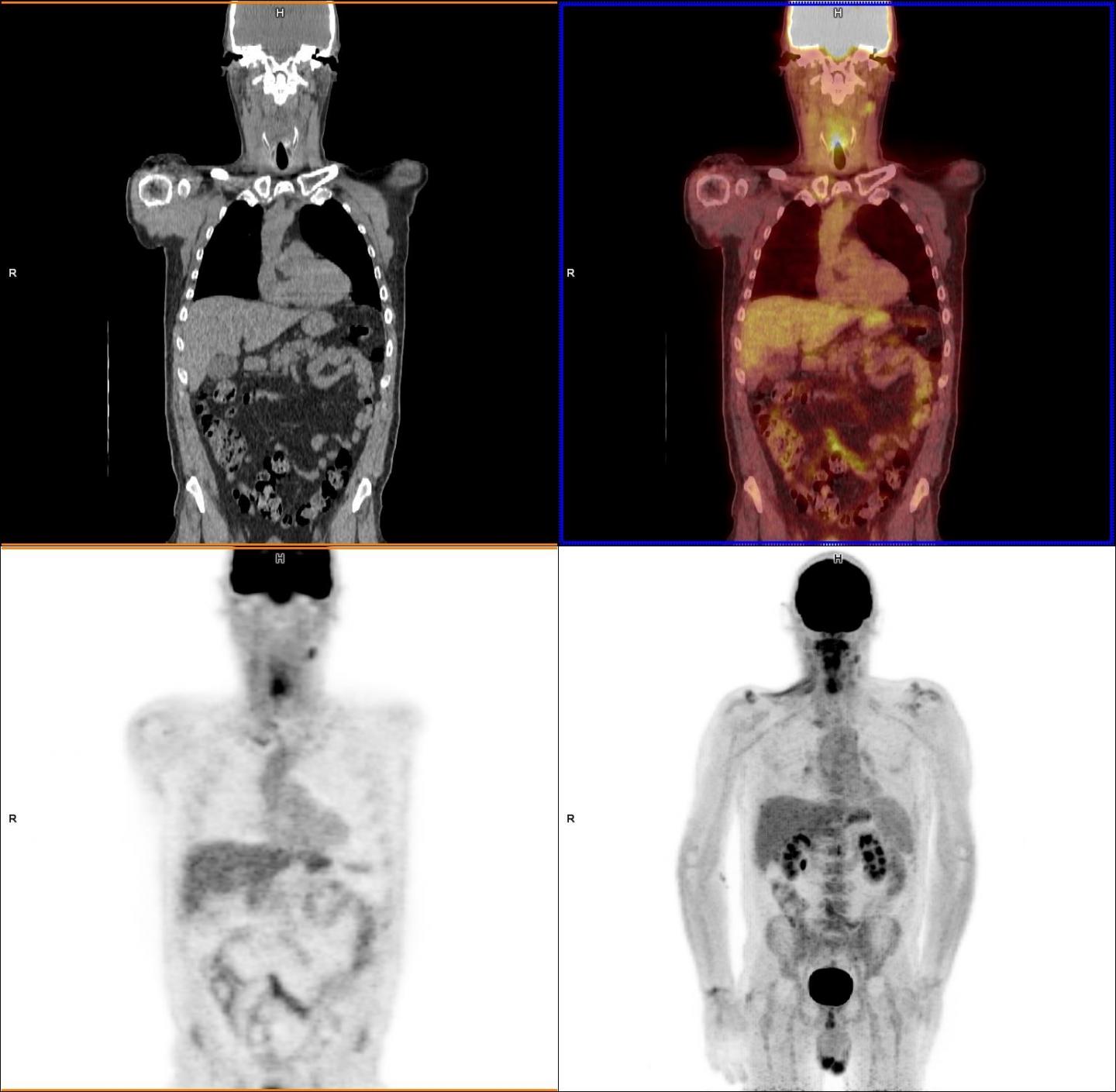 PET NECK Scans