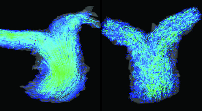 4D Flow Cardiac MRI