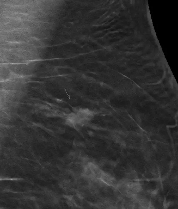 Digital breast tomosynthesis