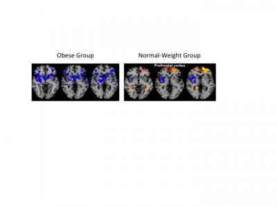 Glucose Acts as a Brake on Food Craving
